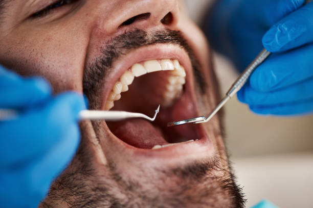 Best Emergency Dental Care for Broken or Chipped Teeth in Selma, AL