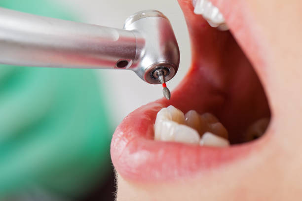 Best Emergency Treatment for Dental Infections or Abscesses in Selma, AL